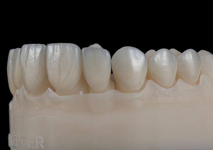 EMAX Veneers