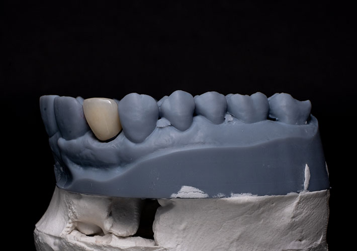 EMAX Veneers