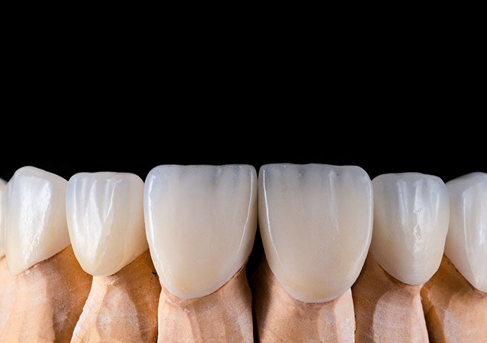 EMAX Veneers