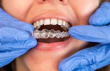 Invisalign Consultation