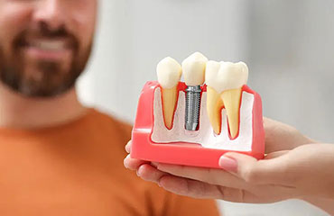 Dental Implants Consultation